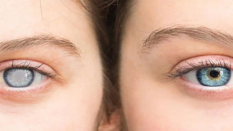 عوامل الخطورة للماء الأبيض